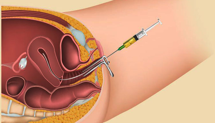 Intrauterine Insemination (IUI) Treatment by Dr. Shilpa Dhameja, Infertility Specialist Vasant Kunj